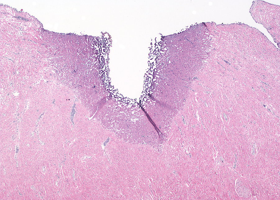 Histological image from initial testing in 2005, showing the laser’s impact on a tissue sample. The Tm fiber laser leaves a clean, distinct cut, or kerf, with little damage to the surrounding tissue. (Credit: N. Fried)
